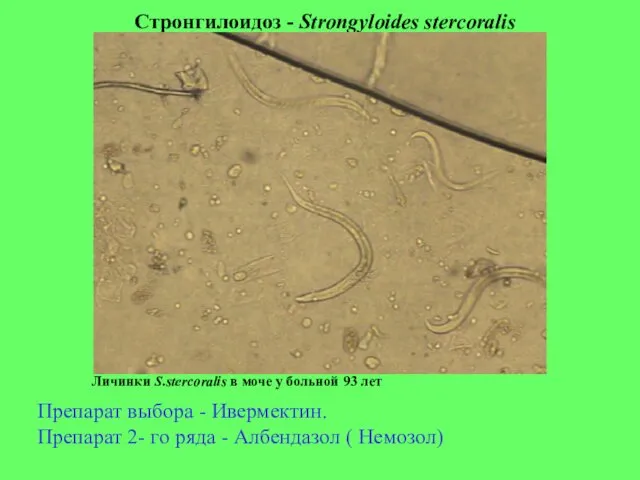 Стронгилоидоз - Strongyloides stercoralis Личинки S.stercoralis в моче у больной 93 лет Препарат