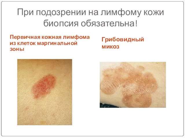 При подозрении на лимфому кожи биопсия обязательна! Первичная кожная лимфома из клеток маргинальной зоны Грибовидный микоз