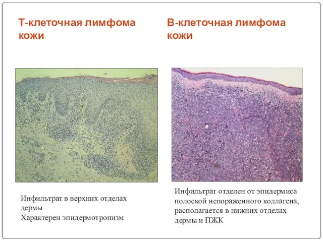 Т-клеточная лимфома кожи В-клеточная лимфома кожи Инфильтрат в верхних отделах дермы Характерен эпидермотропизм