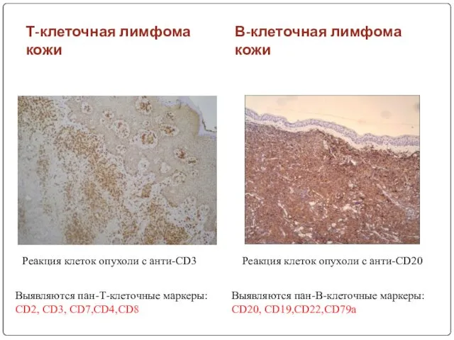 Т-клеточная лимфома кожи В-клеточная лимфома кожи Выявляются пан-Т-клеточные маркеры: CD2, CD3, CD7,CD4,CD8 Выявляются