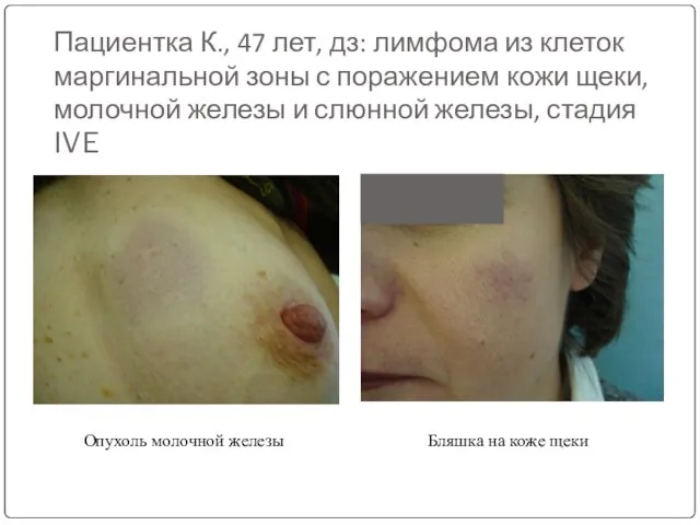 Пациентка К., 47 лет, дз: лимфома из клеток маргинальной зоны с поражением кожи