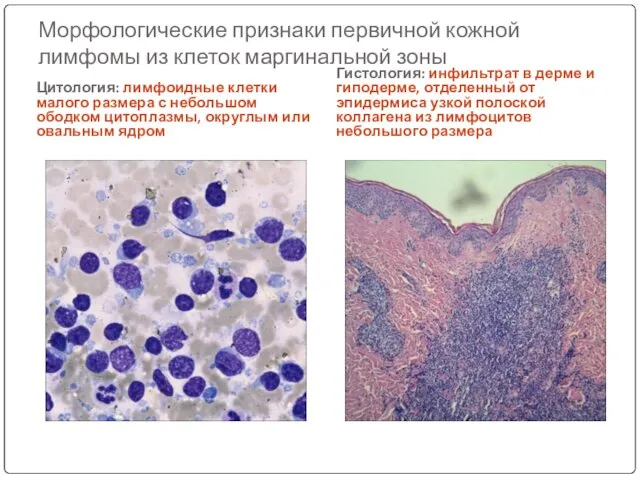Морфологические признаки первичной кожной лимфомы из клеток маргинальной зоны Цитология: лимфоидные клетки малого