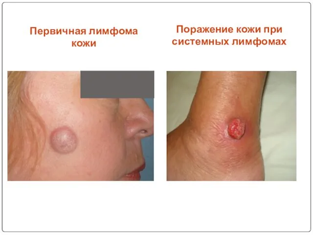 Первичная лимфома кожи Поражение кожи при системных лимфомах
