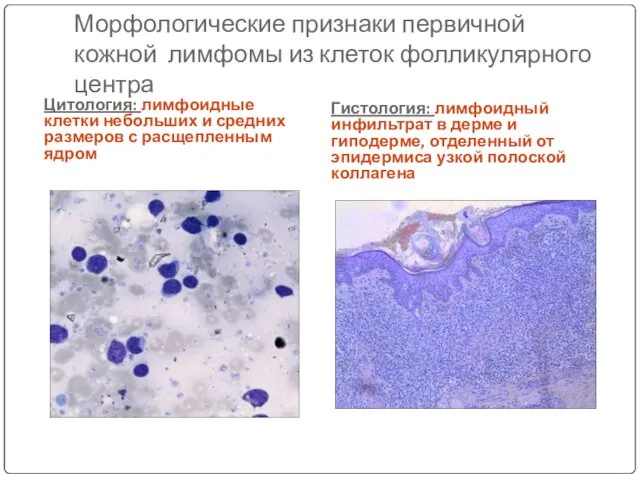 Морфологические признаки первичной кожной лимфомы из клеток фолликулярного центра Цитология: лимфоидные клетки небольших