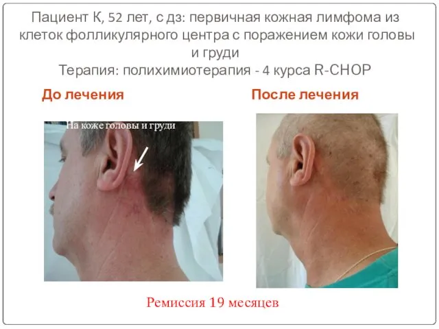 Пациент К, 52 лет, с дз: первичная кожная лимфома из клеток фолликулярного центра