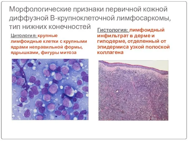 Морфологические признаки первичной кожной диффузной В-крупноклеточной лимфосаркомы, тип нижних конечностей Цитология: крупные лимфоидные