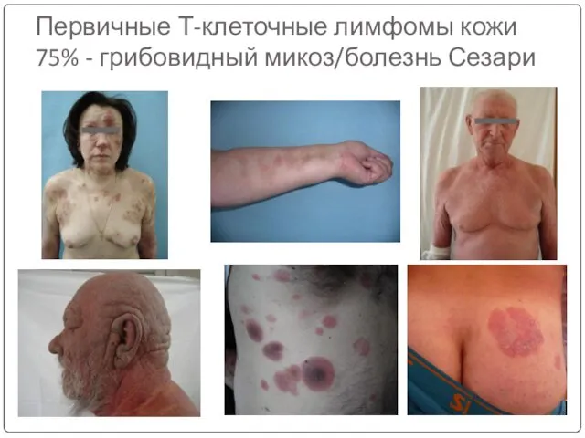 Первичные Т-клеточные лимфомы кожи 75% - грибовидный микоз/болезнь Сезари