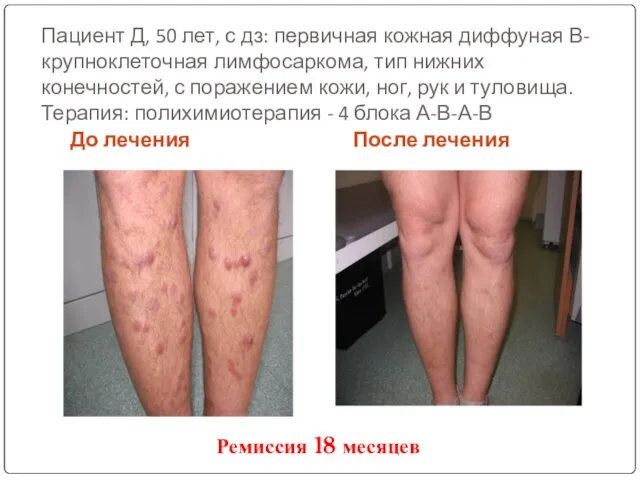 Пациент Д, 50 лет, с дз: первичная кожная диффуная В-крупноклеточная лимфосаркома, тип нижних