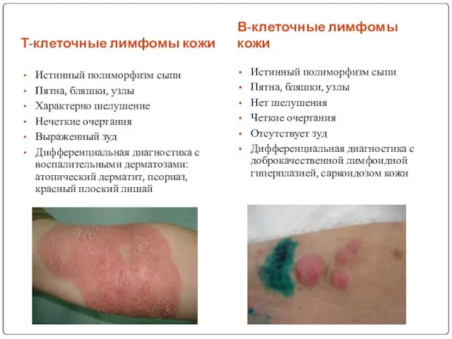 Т-клеточные лимфомы кожи В-клеточные лимфомы кожи Истинный полиморфизм сыпи Пятна, бляшки, узлы Характерно