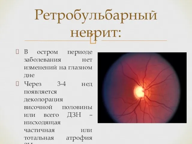 Ретробульбарный неврит: В остром периоде заболевания нет изменений на глазном