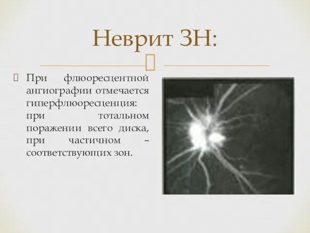 Неврит ЗН: При флюоресцентной ангиографии отмечается гиперфлюоресценция: при тотальном поражении