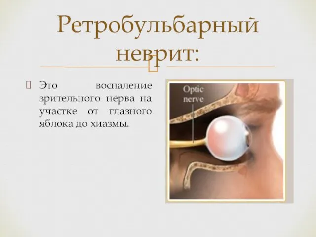 Ретробульбарный неврит: Это воспаление зрительного нерва на участке от глазного яблока до хиазмы.