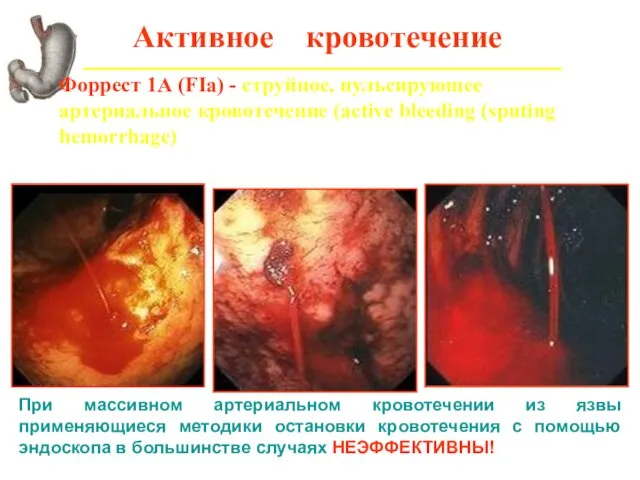 Активное кровотечение Форрест 1А (FIa) - струйное, пульсирующее артериальное кровотечение (active bleeding (sputing