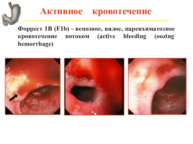Активное кровотечение Форрест 1В (F1b) - венозное, вялое, паренхиматозное кровотечение потоком (active bleeding (oozing hemorrhage)