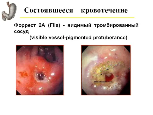 Состоявшееся кровотечение Форрест 2А (FIIa) - видимый тромбированный сосуд (visible vessel-pigmented protuberance)