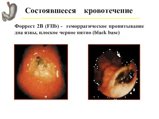 Состоявшееся кровотечение Форрест 2В (FIIb) - геморрагическое пропитывание дна язвы, плоское черное пятно (black base)