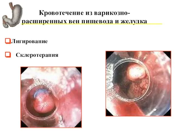 Кровотечение из варикозно-расширенных вен пищевода и желудка Лигирование Склеротерапия