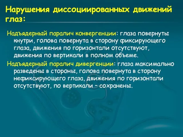 Нарушения диссоциированных движений глаз: Надъядерный паралич конвергенции: глаза повернуты кнутри,