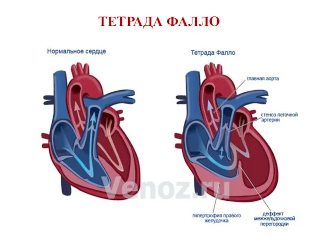 ТЕТРАДА ФАЛЛО