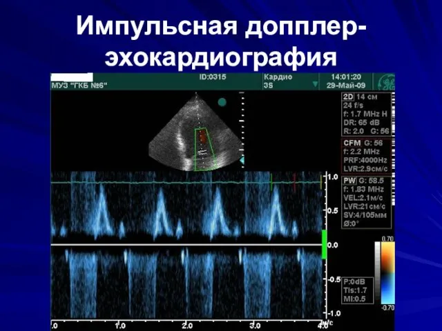 Импульсная допплер-эхокардиография