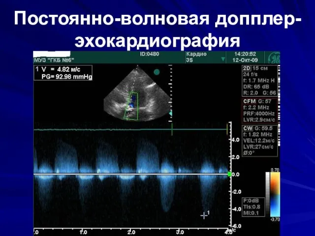 Постоянно-волновая допплер-эхокардиография
