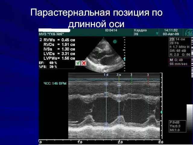 Парастернальная позиция по длинной оси