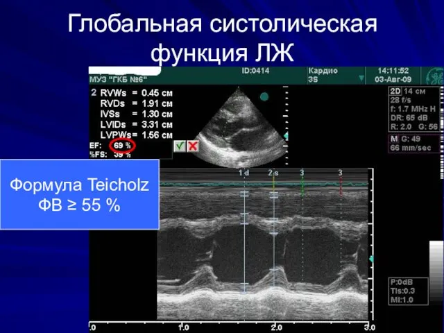 Глобальная систолическая функция ЛЖ Формула Teicholz ФВ ≥ 55 %