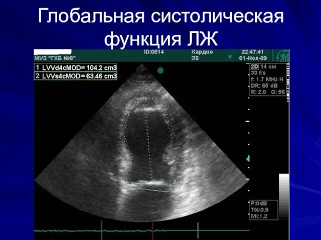 Глобальная систолическая функция ЛЖ