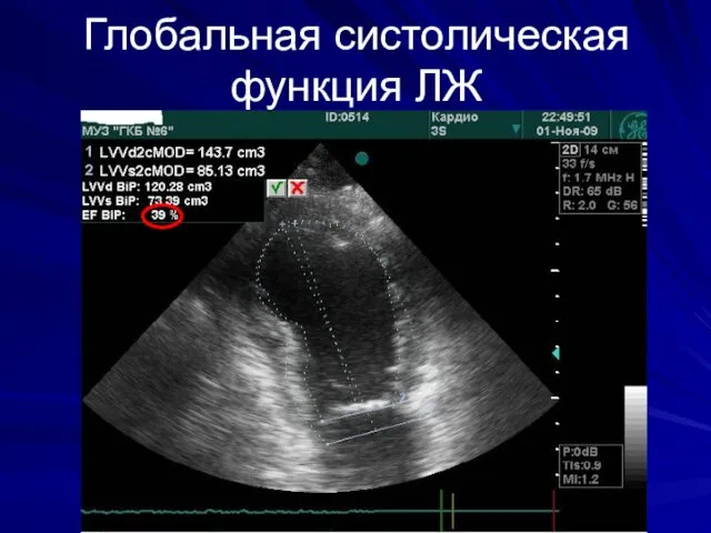 Глобальная систолическая функция ЛЖ