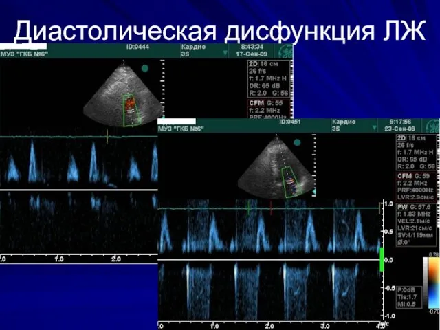 Диастолическая дисфункция ЛЖ