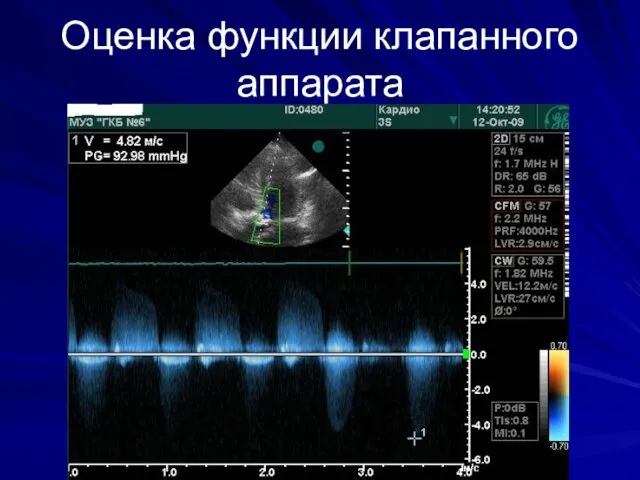 Оценка функции клапанного аппарата