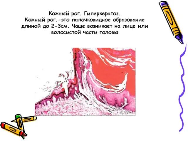 Кожный рог. Гиперкератоз. Кожный рог.-это палочковидное образование длиной до 2-3см.