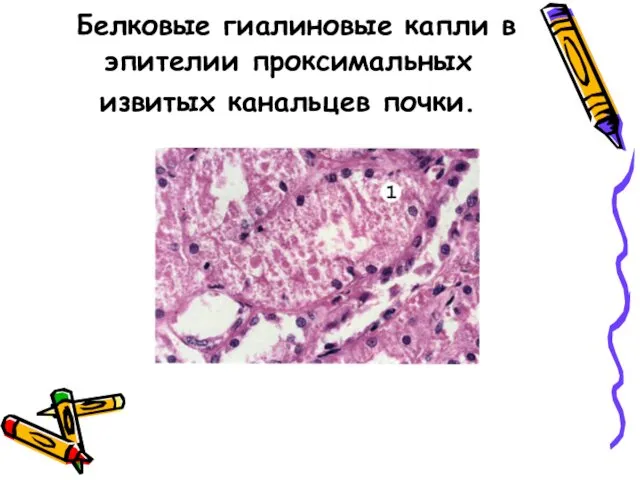 Белковые гиалиновые капли в эпителии проксимальных извитых канальцев почки.