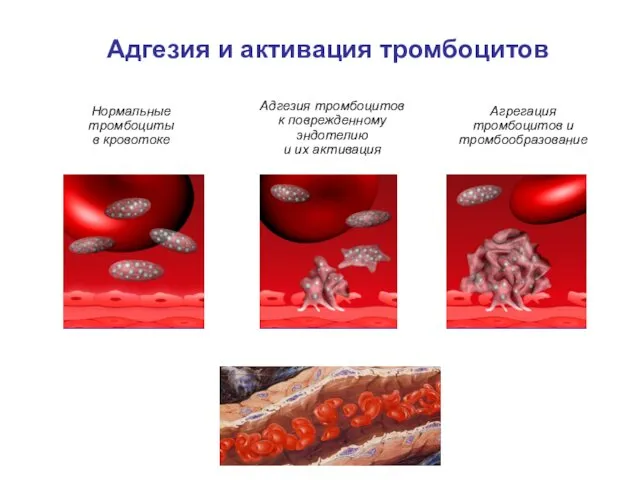 Адгезия и активация тромбоцитов Нормальные тромбоциты в кровотоке Агрегация тромбоцитов