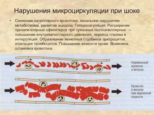 Нарушения микроциркуляции при шоке Снижение капиллярного кровотока, локальное нарушение метаболизма,