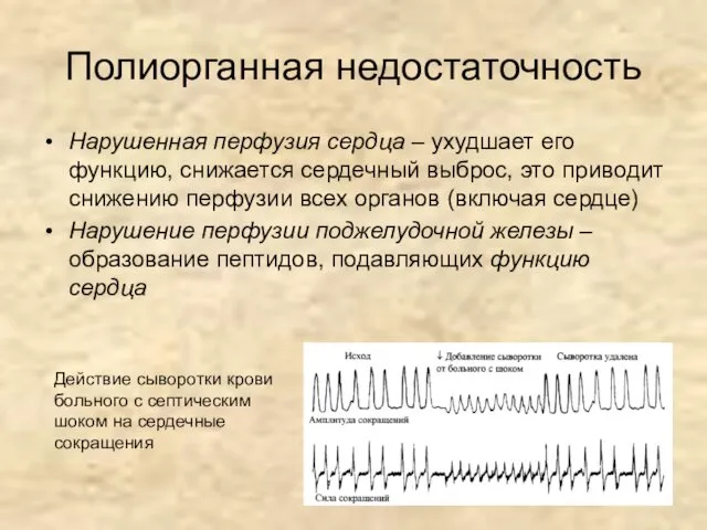 Полиорганная недостаточность Нарушенная перфузия сердца – ухудшает его функцию, снижается