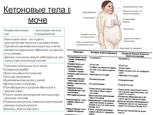 Кетоновые тела в моче