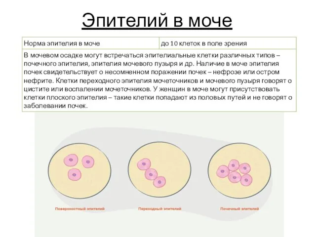 Эпителий в моче