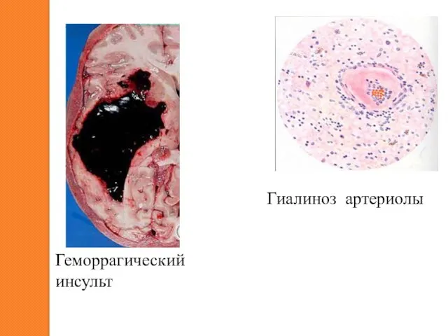 Гиалиноз артериолы Геморрагический инсульт