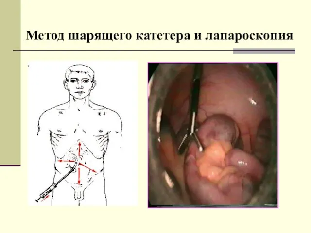 Метод шарящего катетера и лапароскопия