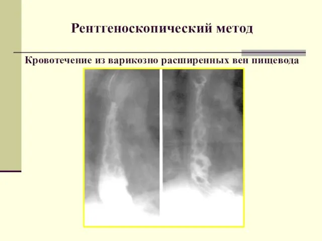 Рентгеноскопический метод Кровотечение из варикозно расширенных вен пищевода