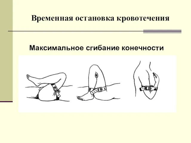 Временная остановка кровотечения Максимальное сгибание конечности