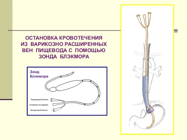 ОСТАНОВКА КРОВОТЕЧЕНИЯ ИЗ ВАРИКОЗНО РАСШИРЕННЫХ ВЕН ПИЩЕВОДА С ПОМОЩЬЮ ЗОНДА БЛЭКМОРА