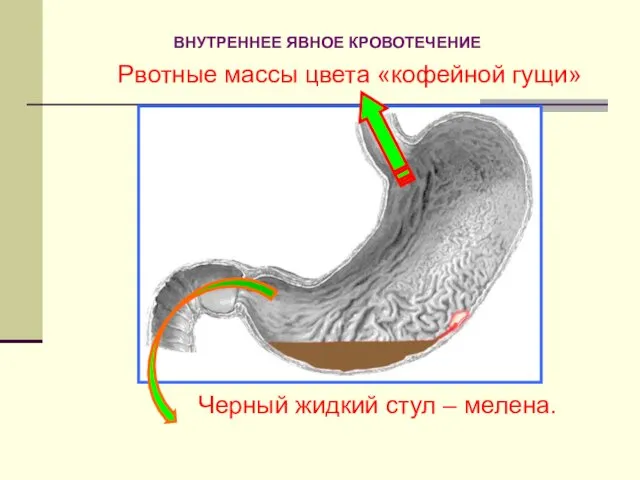 Рвотные массы цвета «кофейной гущи» Черный жидкий стул – мелена. ВНУТРЕННЕЕ ЯВНОЕ КРОВОТЕЧЕНИЕ