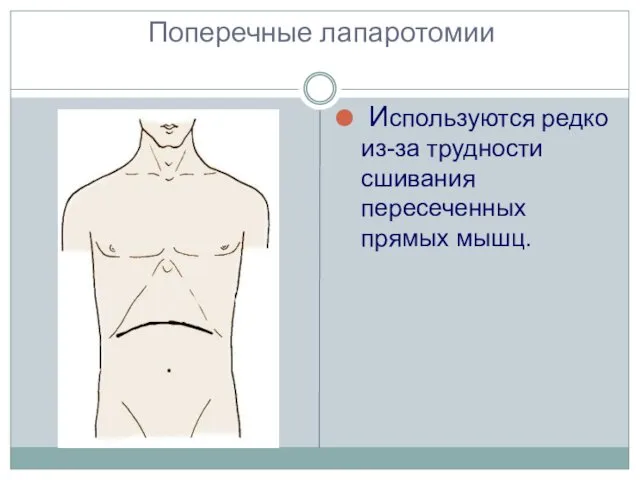 Поперечные лапаротомии Используются редко из-за трудности сшивания пересеченных прямых мышц.