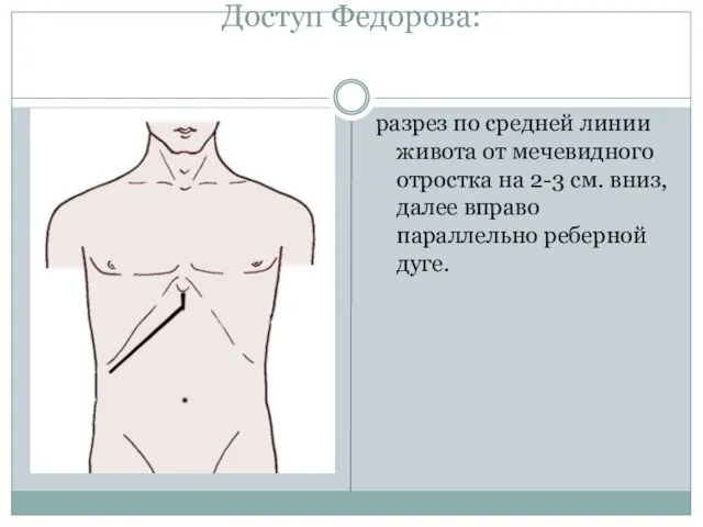 Доступ Федорова: разрез по средней линии живота от мечевидного отростка