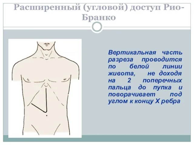 Расширенный (угловой) доступ Рио-Бранко Вертикальная часть разреза проводится по белой