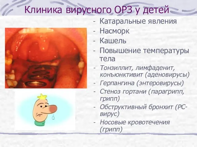 Клиника вирусного ОРЗ у детей Катаральные явления Насморк Кашель Повышение