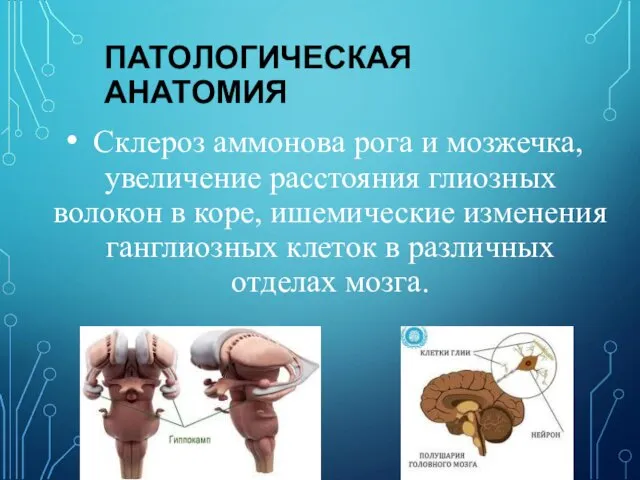 ПАТОЛОГИЧЕСКАЯ АНАТОМИЯ Склероз аммонова рога и мозжечка, увеличение расстояния глиозных