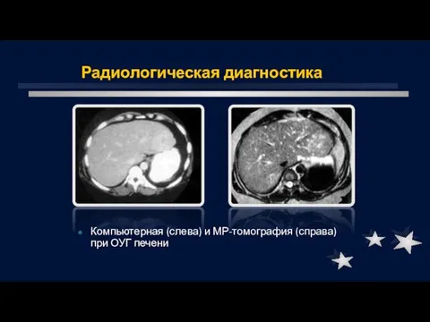 Радиологическая диагностика Компьютерная (слева) и МР-томография (справа) при ОУГ печени